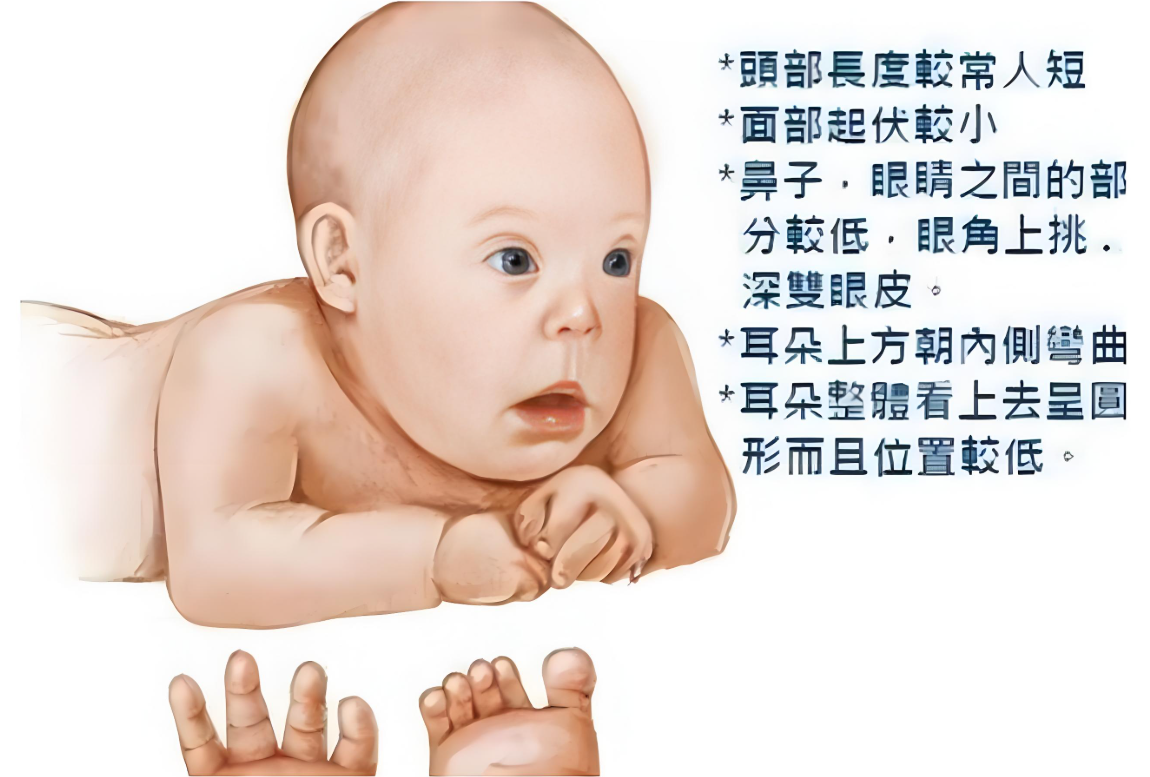 世界唐氏综合征日：重视产前筛查 孕育健康宝宝