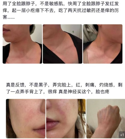 “居家水光”：是院线平替，还是毁肤陷阱？ 第 3 张